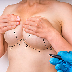 Breast Lift in Beverly Hills, CA